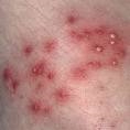 bacterial skin lesion